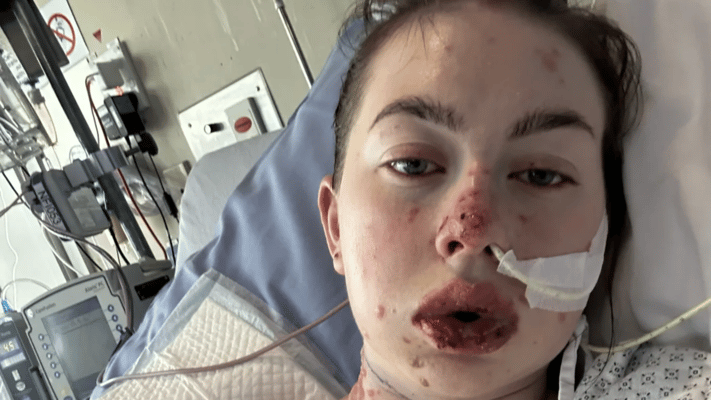 Charlotte Gilmour spent a month in Palmerston North Hospital being treated for Stevens-Johnson syndrome