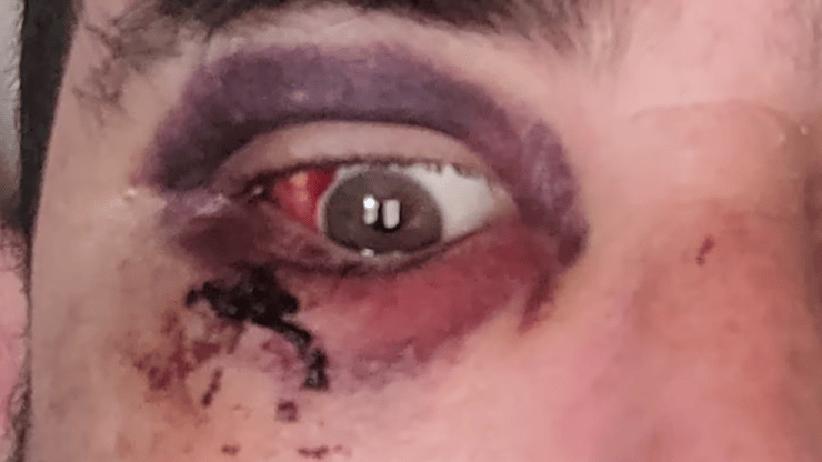 Auckland Man Suffers Broken Eye Socket in Train Assault