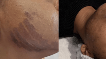 Beauty Treatment Leaves Auckland Woman With Facial Burns