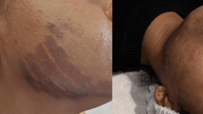 Beauty Treatment Leaves Auckland Woman With Facial Burns