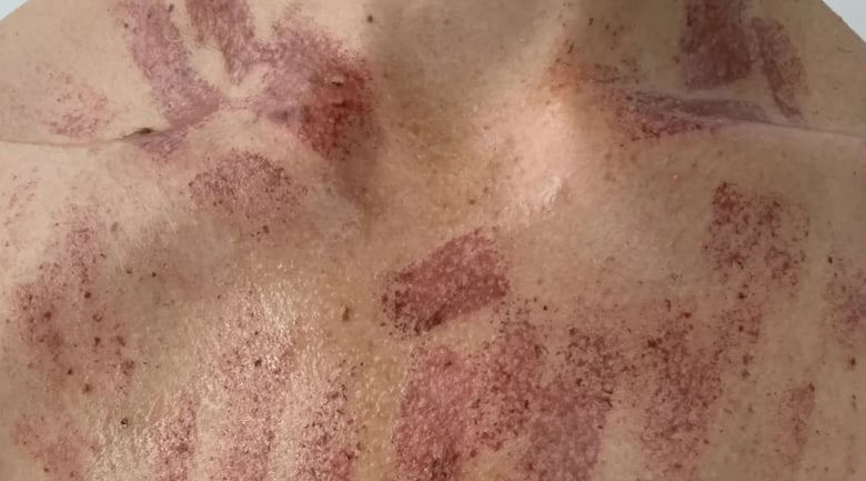 Woman Burned During Beauty Treatment: 'It Was Really Terrifying'