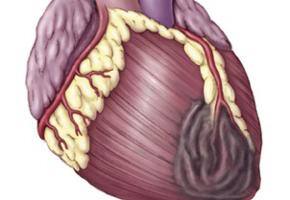 Studies confirm high cardiovascular risk for Indians