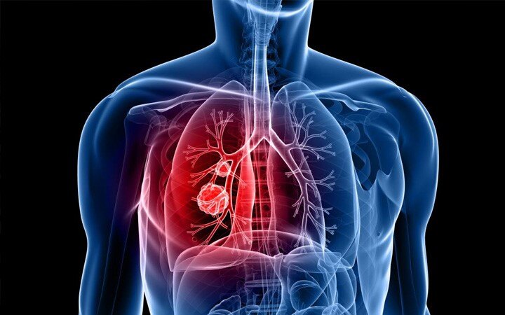 Lung cancer: Know the things that matter