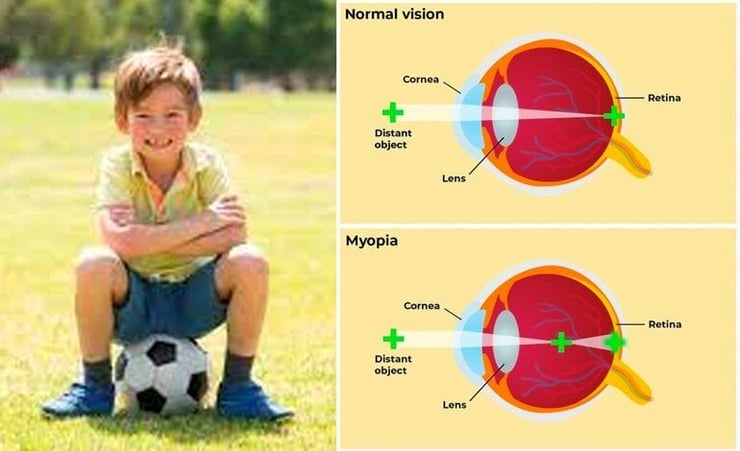 Myopia: Top four tips to protect your child’s eyesight