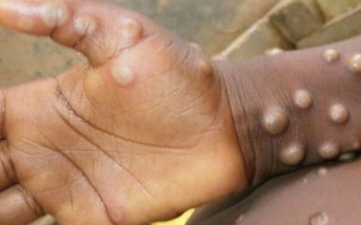 Canada confirms 58 cases of monkeypox
