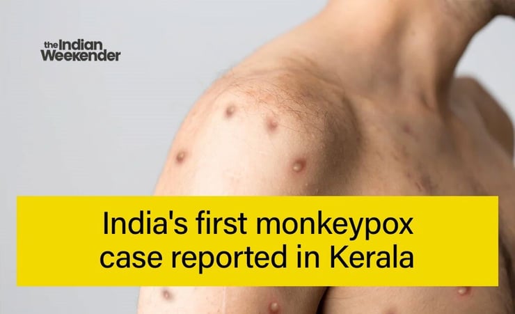 India's first monkeypox case reported in Kerala, Centre rushes high-level team