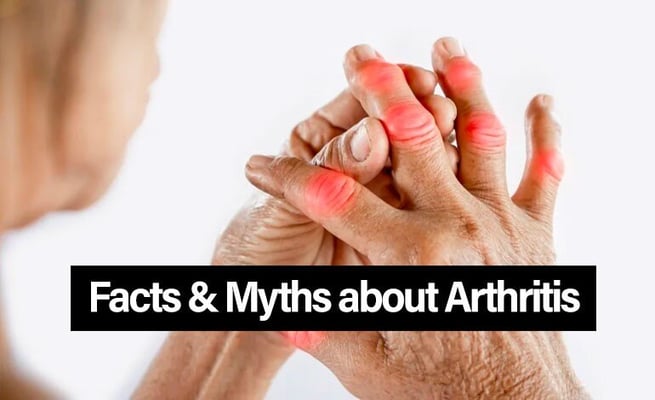 Here are some facts and myths about arthritis that you should be aware of