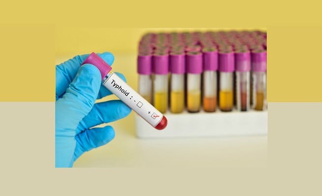 Typhoid outbreak confirmed in Auckland